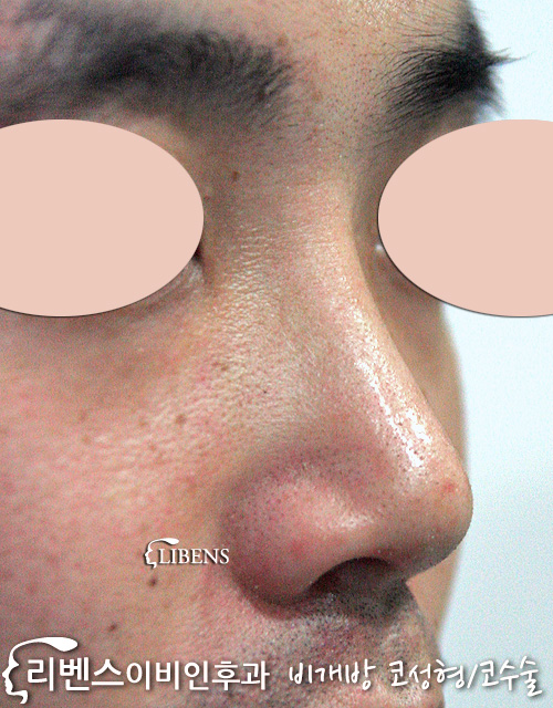 남자 콧대 성형 수술 높이기 코끝 비중격 연골 비중격만곡증 성형 s147